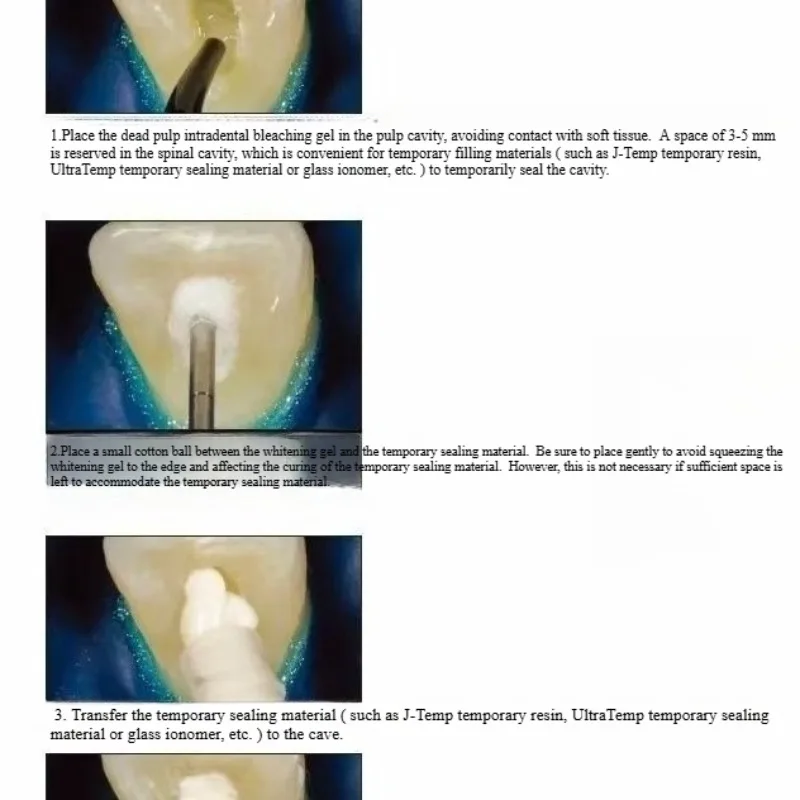 Dental Oral Restoration Materi - Teeth Whitening Effects 评论和价格